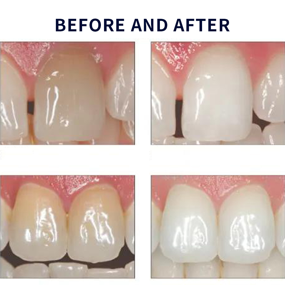 Opalescence Whitening 20% PF 2 - Teeth Whitening Near Me recensie en prijs