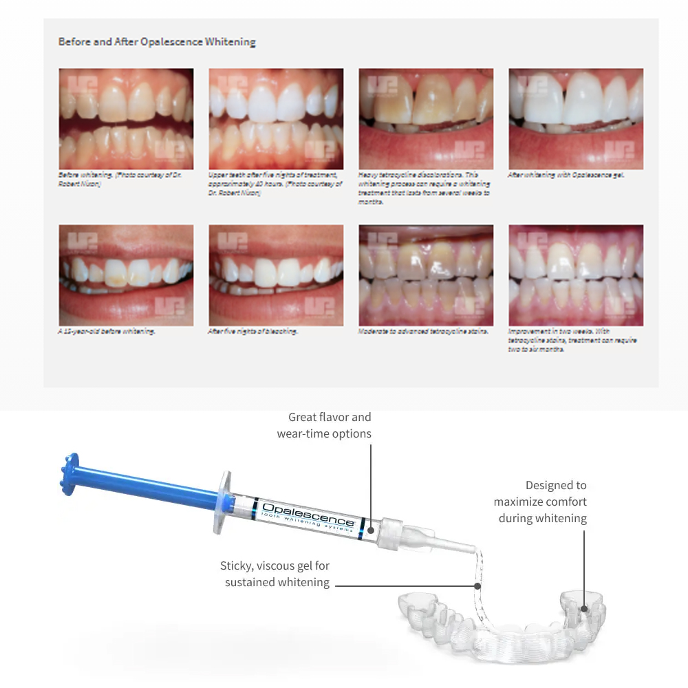 Opalescence Whitening 20% PF 2 - Teeth Whitening Near Me recensie en prijs