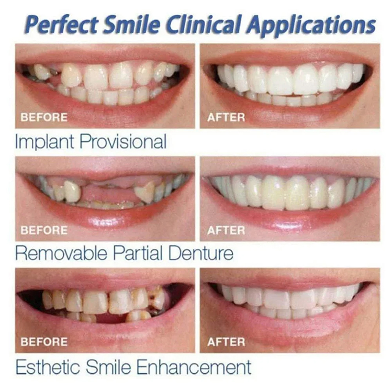Veneer Snap-on Teeth Kit Fake  - Teeth Whitening Session recensie en prijs