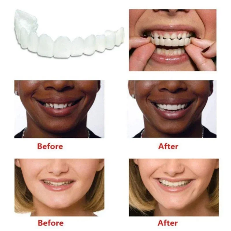 Denture Cover Veneer Snap-on T - Teeth Whitening Session recensie en prijs