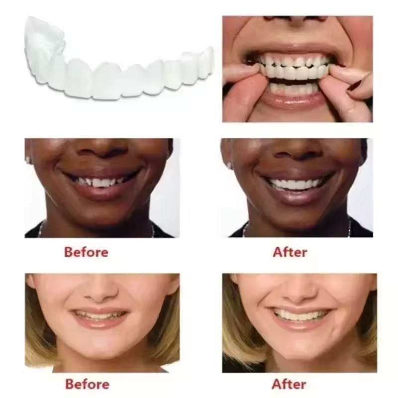 Teeth Veneers Whitening Dentur - Teeth Whitening Session recensie en prijs