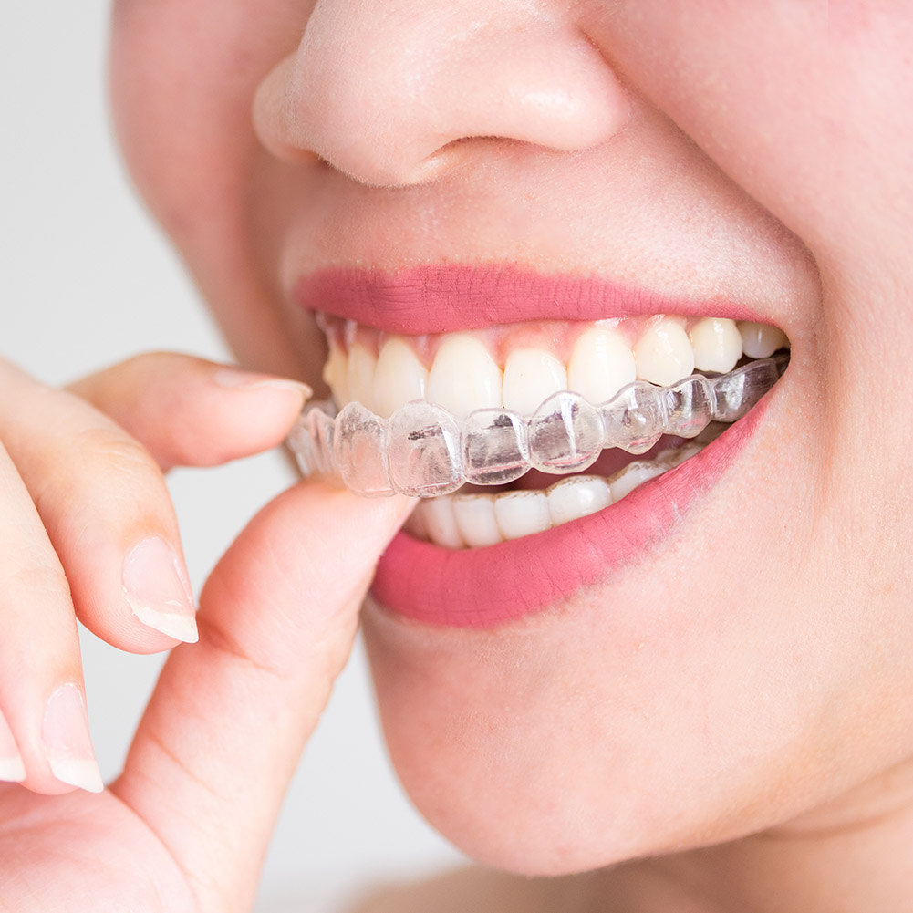 2/4pcs Professional Tooth Orth - Teeth Whitening With Trays recensie en prijs
