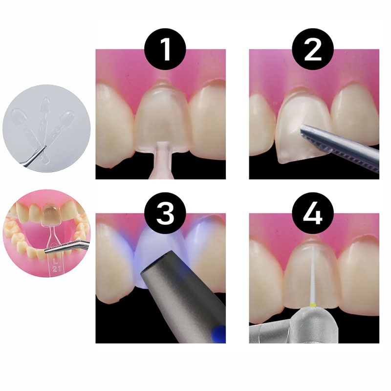 32pcs/Set Composite Resin Mold - Teeth Whitening Moulds recensie en prijs