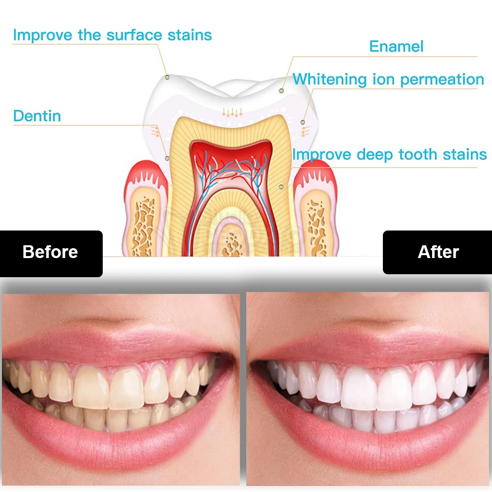 Dental Teeth Whitening Kit Min - Teeth Whitening Ai recensie en prijs