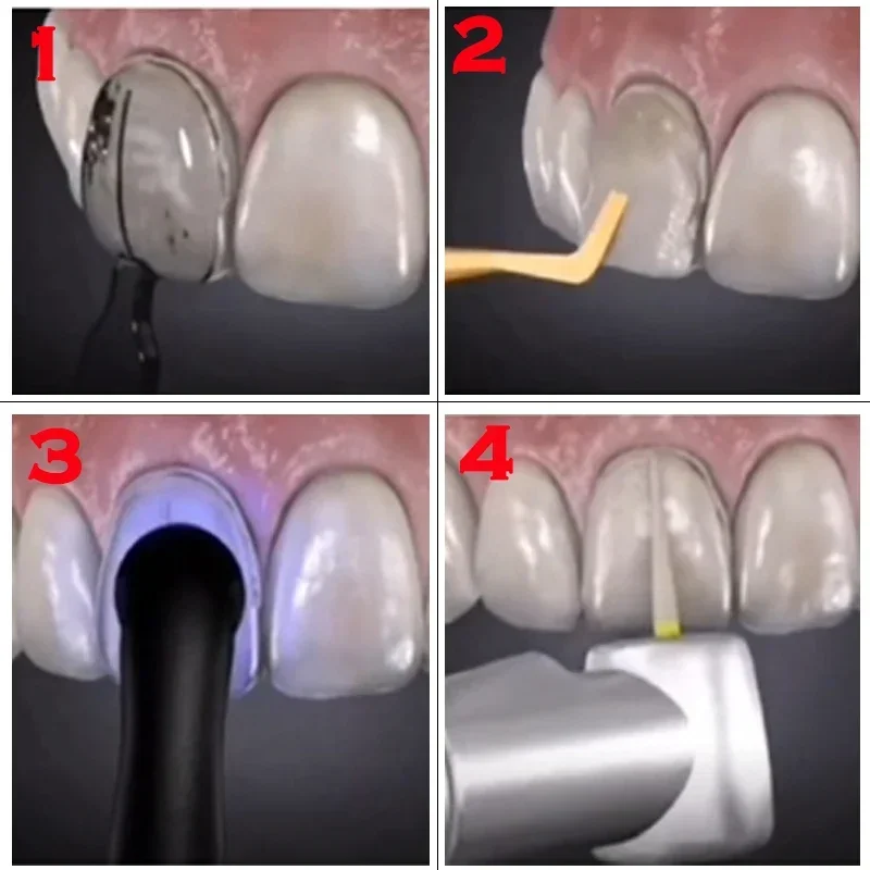 Dental Mould For Composite Res - Teeth Whitening Moulds recensie en prijs