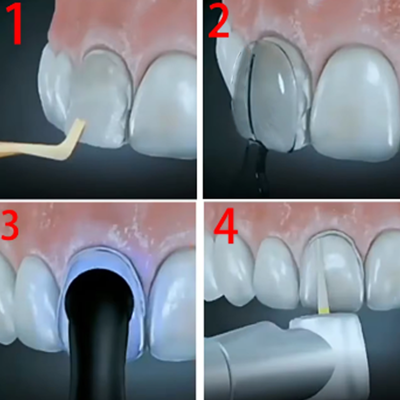 32Pcs/Box Dental Veneer Mould  - Teeth Whitening Moulds recensie en prijs